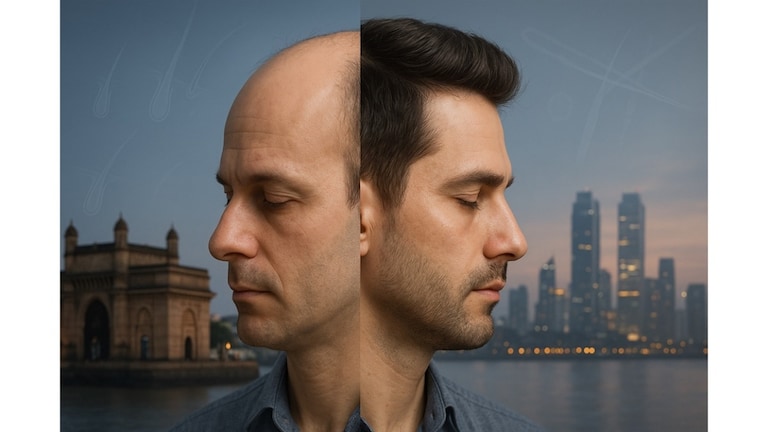 Ïmpact feature: मुंबई का बनत आहे केश-पुनरुज्जीवनाचं केंद्र impact feature why mumbai is becoming a hub for hair rejuvenation