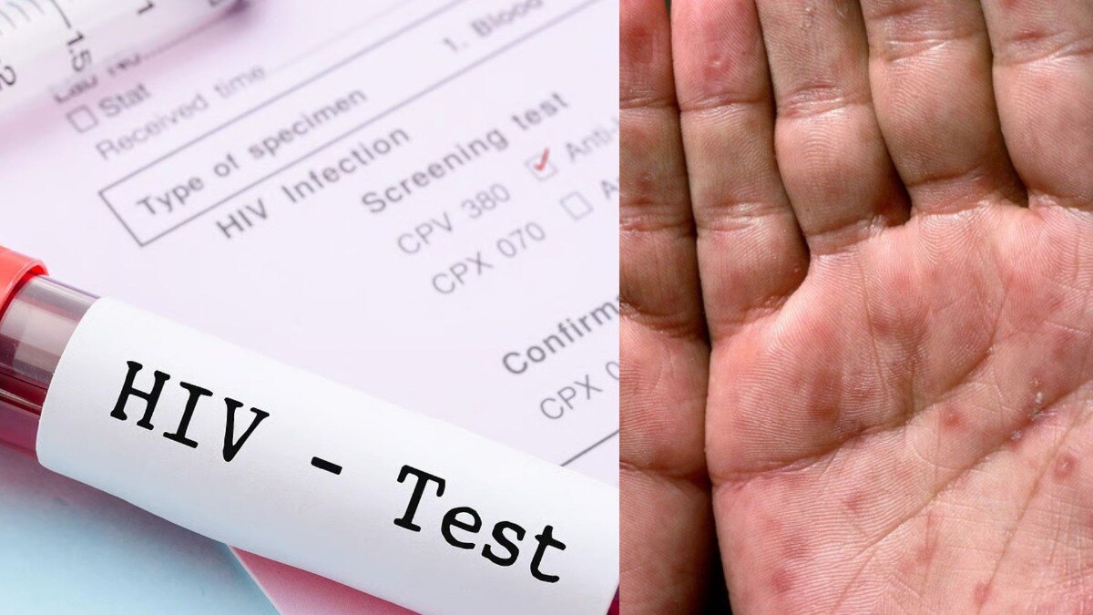 Hiv infection