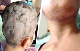 मॉर्निंग वॉकला जाताना पाळीव कुत्र्याने महिलेवर हल्ला करत तोडले लचके, डोक्यासह मानेवर 50 हून अधिक टाके Crime News