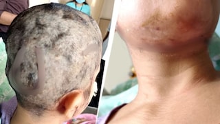 मॉर्निंग वॉकला जाताना पाळीव कुत्र्याने महिलेवर हल्ला करत तोडले लचके, डोक्यासह मानेवर 50 हून अधिक टाके Mumbai Tak