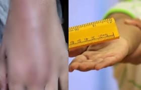 नवी मुंबई : ट्यूशन टीचरने आठवीच्या मुलीला लाकडी पट्टीने दिले 40 फटके, पीडितेचे सुजले हात Navi Mumbai