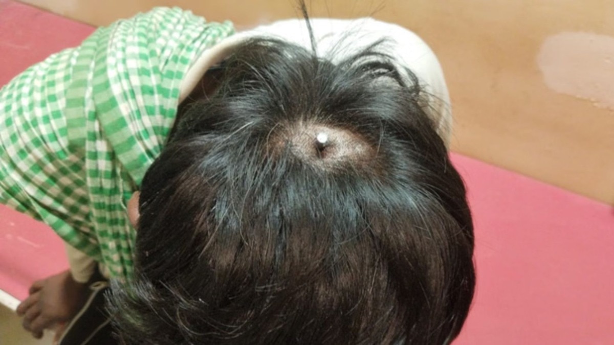 मुलाच्या डोक्यात हातोड्याने ठोकला अडीच इंचाचा लोखंडी खिळा, वडील अन् भावाचं कृत्य; मुलाचं काय झालं?