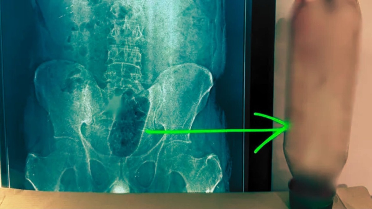 नवविवाहित तरुणाच्या गुद्दद्वारात 36 तास पाण्याची बाटली अडकली, शस्त्रक्रियेनंतर डॉक्टरांनी सांगितलं धक्कादायक कारण