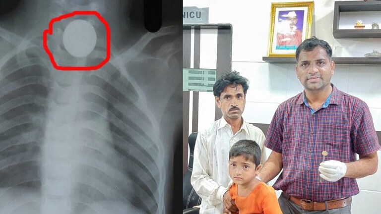 डॉक्टरांची कमाल ! ना बेशुद्ध केलं ना शस्त्रक्रीया केली, मुलीच्या गळ्यात अडकलेलं नाणं काढलं बाहेर Mumbai Tak