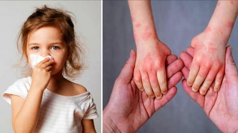 भारतात वेगाने पसरतोय ‘टोमॅटो फ्लू’; लक्षणं काय आहेत आणि कुणाला आहे संसर्गाचा धोका? Mumbai Tak