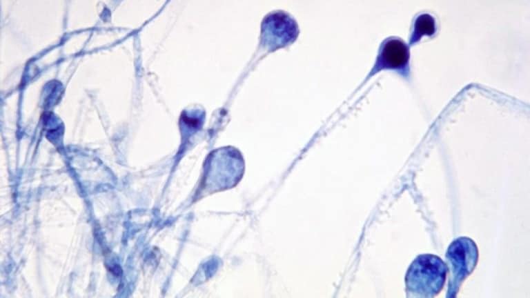 Mucormycosis च्या रूग्णांना मोठा दिलासा, राज्य सरकारकडून उपचारांचे दर निश्चित Mumbai Tak
