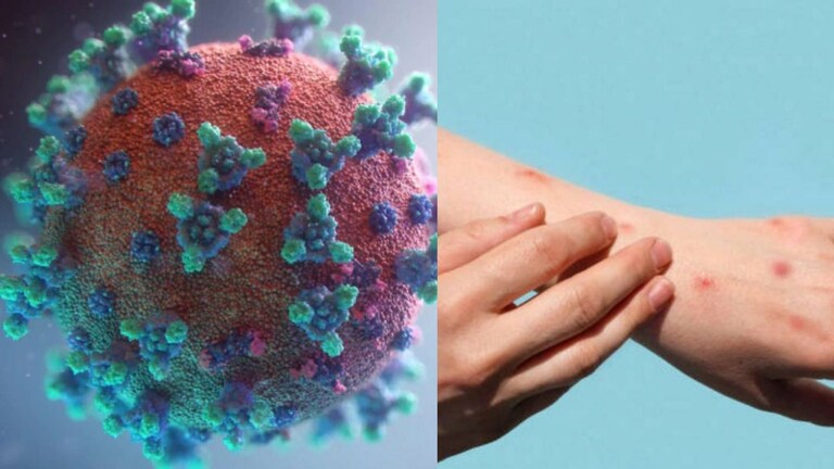 मंकीपॉक्स आहे की कोरोना, कसं ओळखायचं? 10 मुद्द्यांमधून समजून घ्या दोन्ही आजारांमधील फरक Mumbai Tak