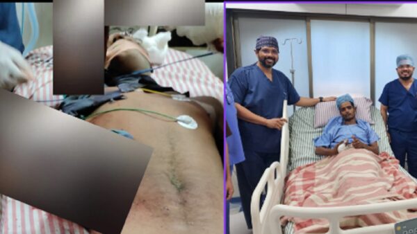 bamboo passed through worker's stomach doctor saved life after 9 hours of surgery kalyan story
