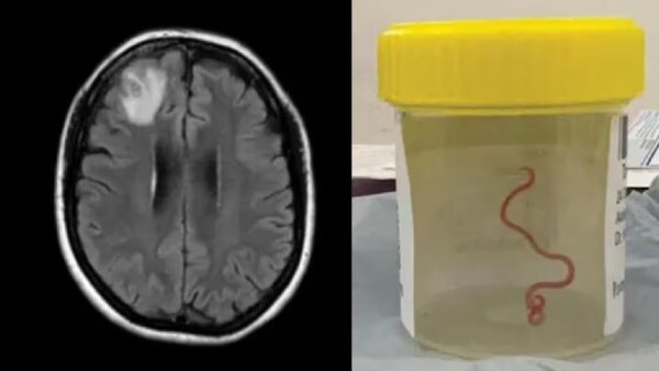 Parasitic worm, Australian Women brainpython worm living in women brain doctors also shock australia story