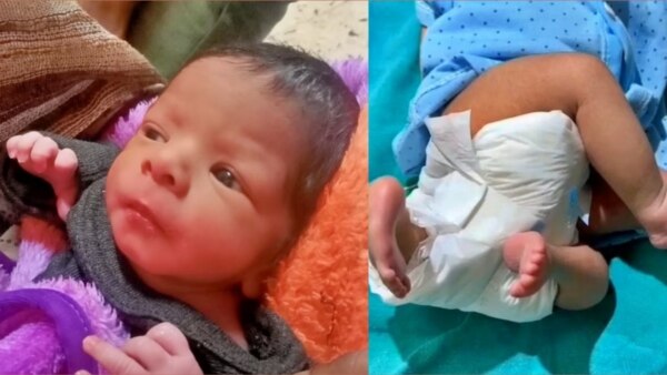 newborn baby has four legs and three arms