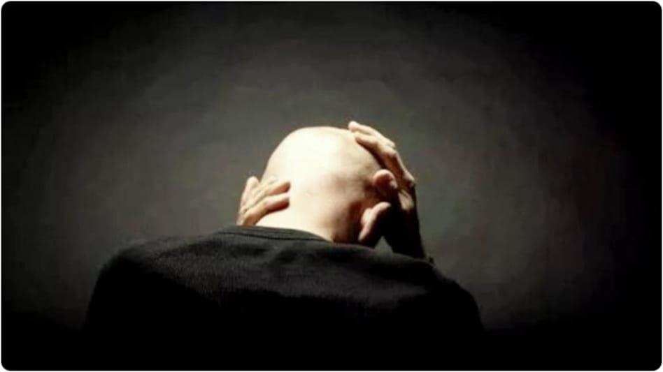 Hair Loss and Baldness পুরুষদের দ্রুত টাকা পড়ার কারণ হতে পারে এনার্জি