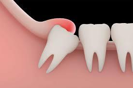 Wisdom Tooth