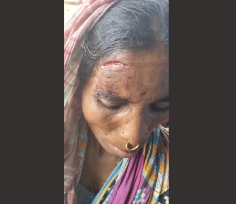 लाठीचार्ज में घायल एक महिला; स्थानीय लोगों का कहना है पुलिस ने उन पर बेवजह लाठियां बरसाईं