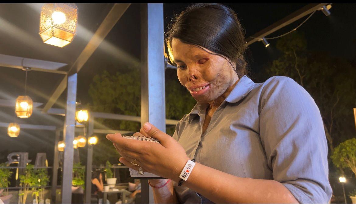 acid attack survivors 