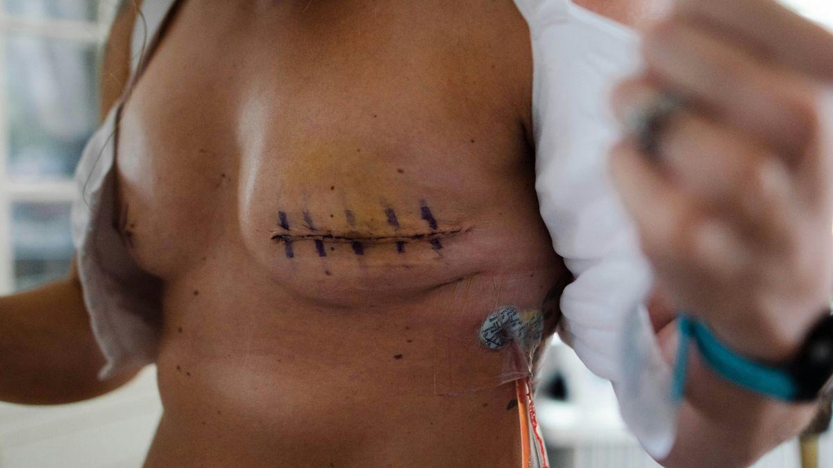 Male Breast Cancer