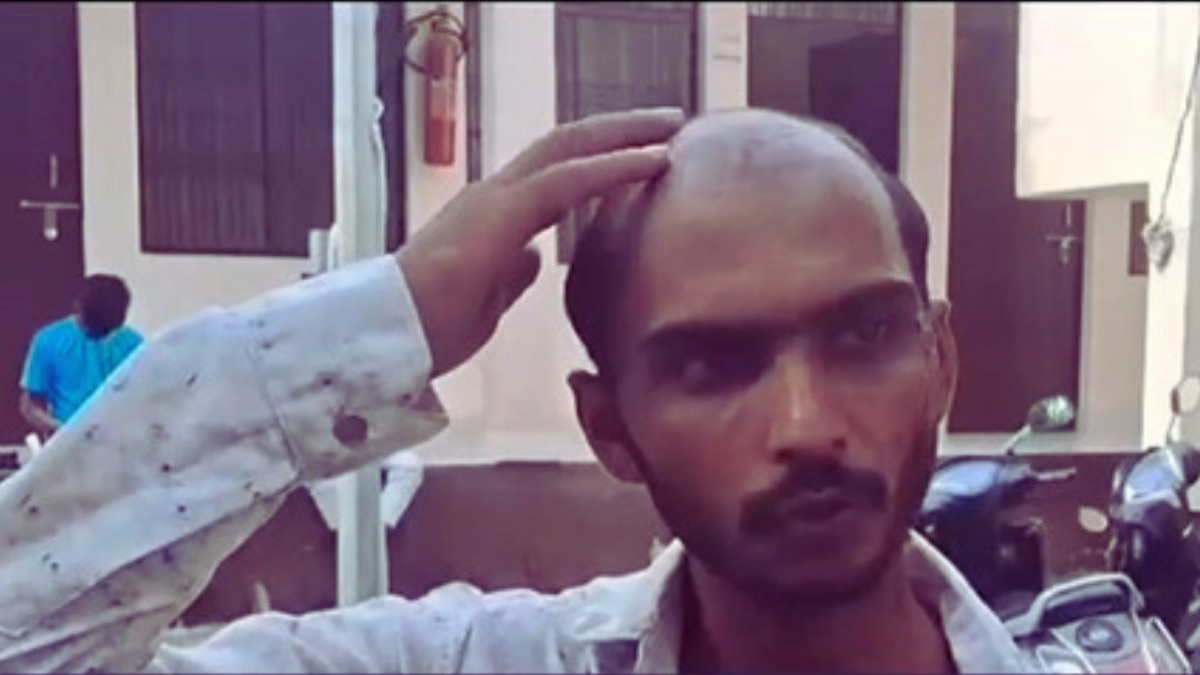 देवरिया में झगड़े के बीच साला उखाड़ ले गया जीजा के बाल, गंजे सिर को दिखाते हुए युवक ने बताया अपना दर्द