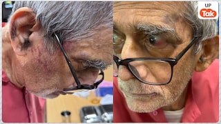 फ्री इलाज करने वाले पद्मश्री से सम्मानित डॉ. टीके लहरी के साथ BHU में मारपीट, गाल और आंख पर दिखे गंभीर चोट के निशान UP Tak