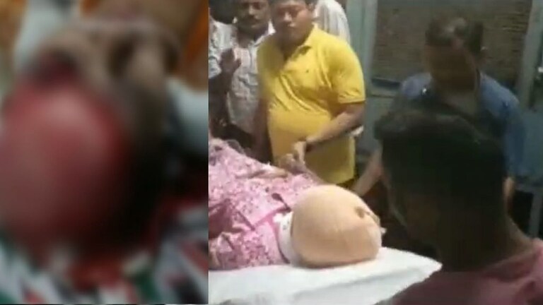 अलीगढ़: किशोरी को सेल्फी लेना पड़ा भारी, जेनरेटर के पंखे ने खींचा बाल, खाल समेत उखाड़ दिया UP Tak