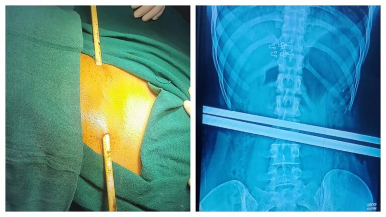 आजमगढ़: बंदर से डर छत से गिरी महिला तो कमर के ऊपर आर-पार हो गई सरिया, सूझबूझ से बच गई जान UP Tak