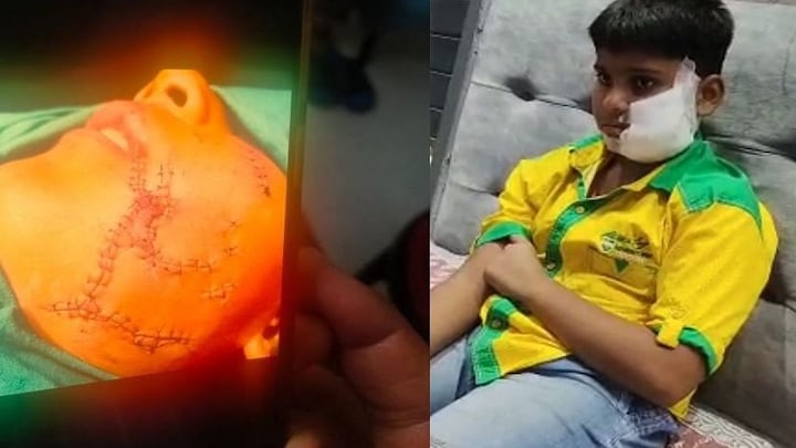 गाजियाबाद: पिटबुल डॉग का खौफनाक अटैक, मासूम के गाल को चीर दिया, आए 150 से ज्यादा टांके UP Tak