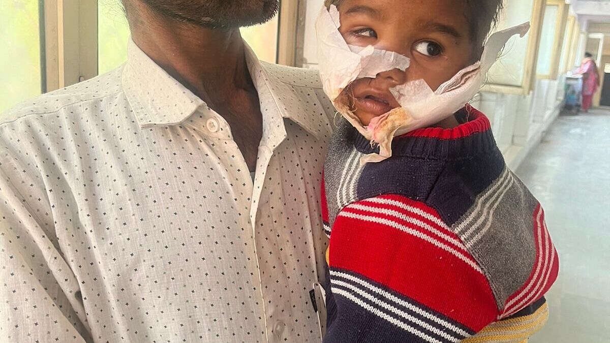गाजियाबाद: सवा साल की बच्ची को कुत्ते ने किया लहुलुहान, चेहरे पर आए 70 टांके, हुई सर्जरी UP Tak