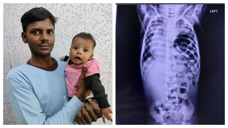 लखनऊ: नवजात शिशु के फेफड़ों में फंस गई थी आंत, KGMU के डॉक्टरों ने इस तकनीक से बचा ली जान UP Tak