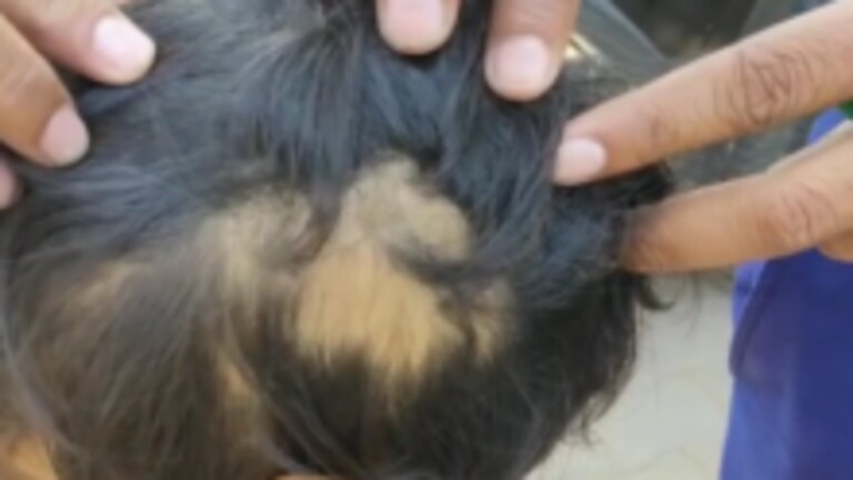 फिरोजाबाद: LKG की छात्रा ने कपड़े किए गंदे तो टीचर ने बेरहमी से पीटा, उखड़ गए सिर के बाल UP Tak