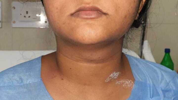 लखनऊ: एसजीपीजीआई ने फिर रचा इतिहास, इस विधि से निकाला थायरॉइड कैंसर का ट्यूमर UP Tak