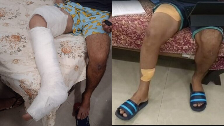 पिटबुल के बाद अब रॉट विलर का आतंक! कुत्ते ने युवक के पैर को ऐसे काटा कि करानी पड़ी सर्जरी UP Tak