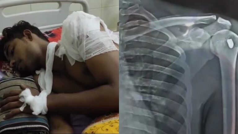 गाजीपुर में दबंगों ने युवक के कंधे में मारी गोली, पुलिस ने बताया इसे मारपीट, अब हुआ ये एक्शन UP Tak