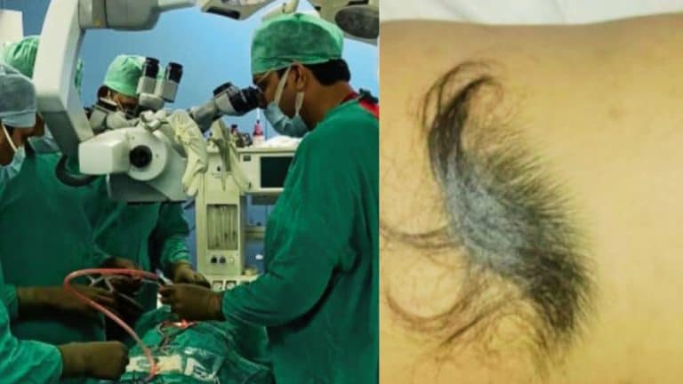 आगरा में डॉक्टरों ने 9 साल के बच्चे की रीढ़ की हड्डी से निकाला बालों का गुच्छा, उसे थी ये बीमारी UP Tak