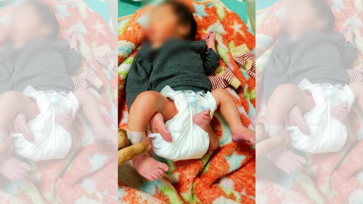 मेरठ में इरफान के घर जन्मा 4 पैर और 3 हाथ वाला बच्चा! डॉक्टर ने बताया आखिर क्यों हुआ ऐसा UP Tak