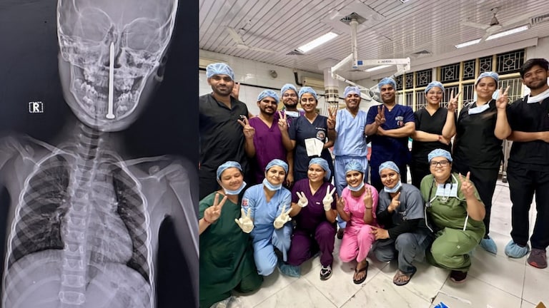 KGMU के डॉक्टरों ने 10 घंटे में 7 साल के बच्चे की जान बचाई, गर्दन से दिमाग तक पहुंची थी 8 CM लंबी कील Lucknow KGMU News