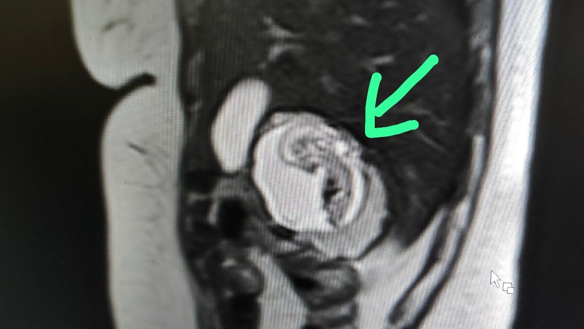 UP Woman’s Foetus Growing In Liver, Not Uterus.
