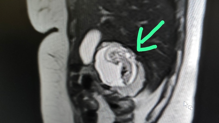 30 साल की इस महिला के गर्भ में नहीं लीवर में पल रहा भ्रूण! मेरठ जैसा ये केस नहीं देखा होगा आपने UP Woman’s Foetus Growing In Liver, Not Uterus.
