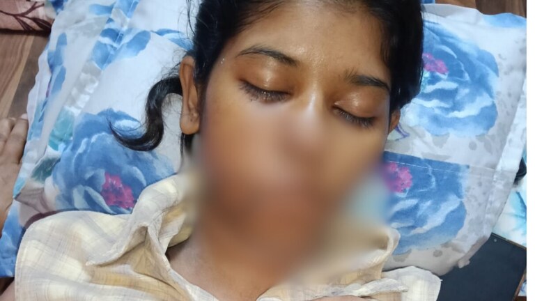 कानपुर में आवारा कुत्तों ने 21 साल की वैष्णवी के चेहरे को बुरी तरह नोच डाला, गाल दो हिस्सों में फट गए... 17 टांके लगे Kanpur Stray Dogs Attack News