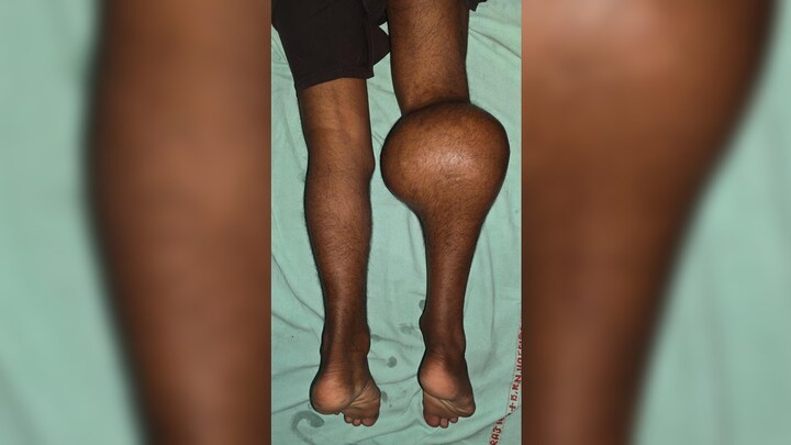 पैर से निकला 2 किलो का 15 सेमी लंबा ट्यूमर... प्रयागराज के सुनील कुमार को क्या हुआ था? tumor removed from leg