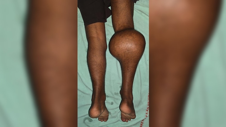 पैर से निकला 2 किलो का 15 सेमी लंबा ट्यूमर... प्रयागराज के सुनील कुमार को क्या हुआ था? tumor removed from leg