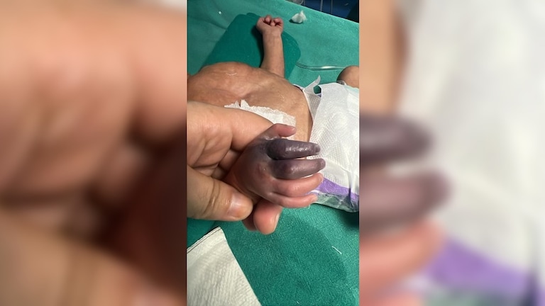 5 अक्टूबर को पैदा हुई बच्ची और ग्रेटर नोएडा में ऐसा इंजेक्शन लगा दिया कि नीला-काला पड़कर गलने लगा हाथ! Greater Noida medical negligence