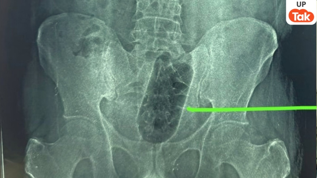 Agra, Agra News, Agra Viral News, Agra News, Agra News, Agra Viral, UP Viral News, UP Viral, Anal Sex, Anal Sex, UP News, आगरा, आगरा न्यूज, आगरा वायरल न्यूज, आगरा की खबरें, आगरा के समाचार, आगरा वायरल, यूपी वायरल न्यूज, यूपी वायरल, गुदामैथुन