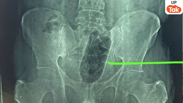 आगरा में इस युवक ने मलाशय में डाल ली एक लीटर वाली प्लास्टिक बोतल! फिर 36 घंटों तक रहा बेचैन Agra, Agra News, Agra Viral News, Agra News, Agra News, Agra Viral, UP Viral News, UP Viral, Anal Sex, Anal Sex, UP News, आगरा, आगरा न्यूज, आगरा वायरल न्यूज, आगरा की खबरें, आगरा के समाचार, आगरा वायरल, यूपी वायरल न्यूज, यूपी वायरल, गुदामैथुन