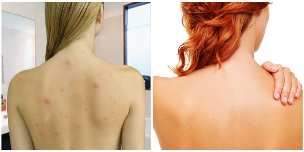5 Super Easy Home Remedies To Get Rid Of Back Acne Beauty Cosmopolitan India