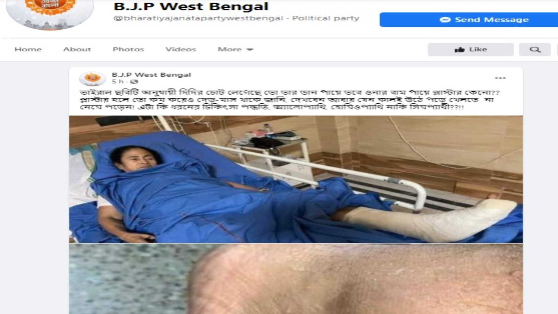 ডান-পা নয়, নন্দীগ্রামে মমতা বন্দ্যোপাধ্যায় বাঁ-পায়ে চোট পেয়েছেন