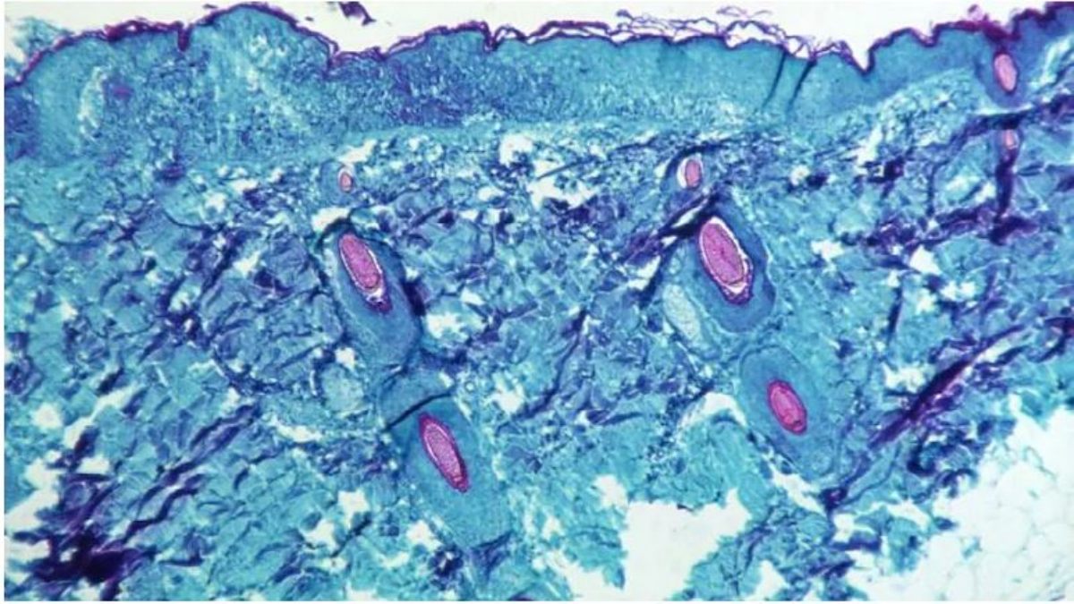 5 FAQs on monkeypox answered 5 FAQs on monkeypox answered