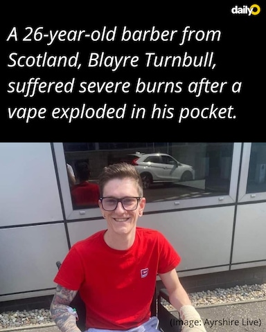 Scotland man suffers severe burns after vape explodes in pocket Scotland man suffers severe burns after vape explodes in pocket