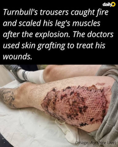 Scotland man suffers severe burns after vape explodes in pocket Scotland man suffers severe burns after vape explodes in pocket