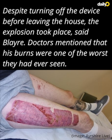 Scotland man suffers severe burns after vape explodes in pocket Scotland man suffers severe burns after vape explodes in pocket