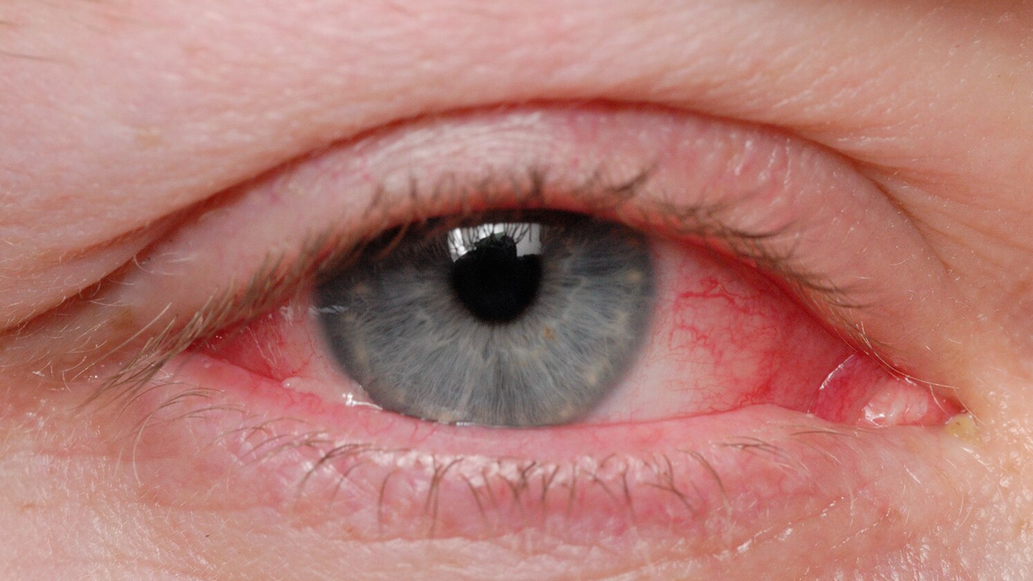 Delhi is seeing 100+ conjunctivitis cases daily this monsoon. What to do if you get it