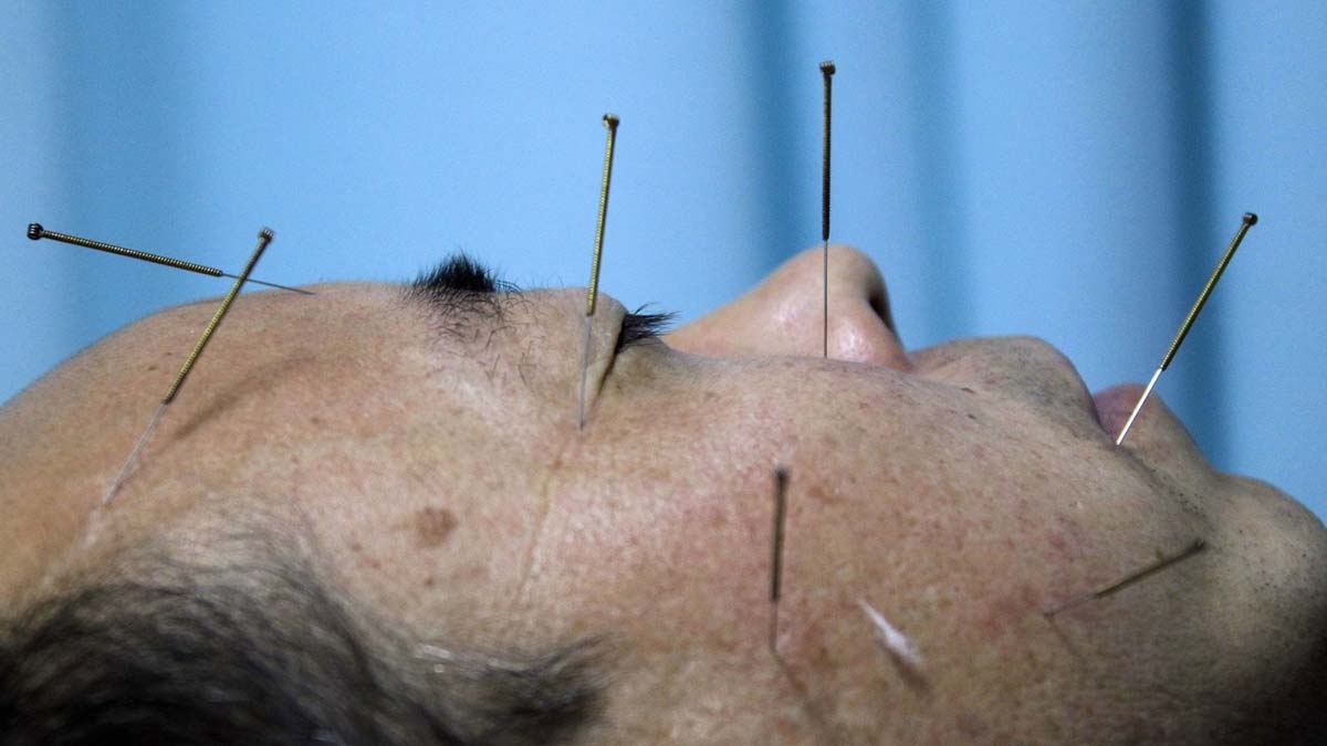 How acupuncture helps treat postCovid complications