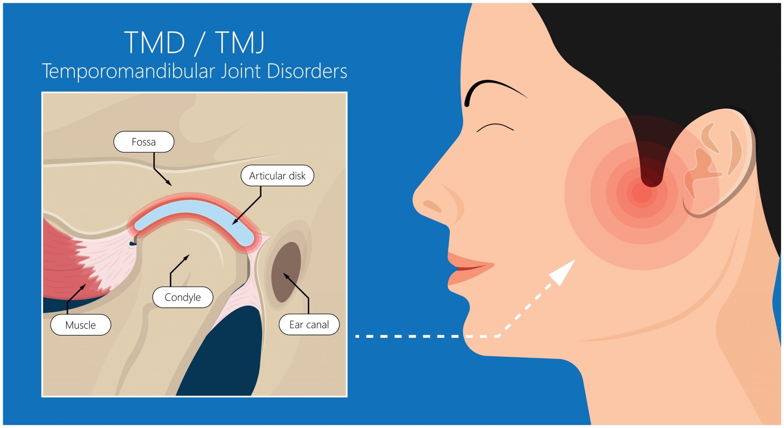 What is TMJ, which can lead to your jaw locking when you stress too much?